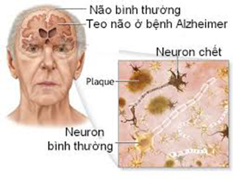 Alzheimer là bệnh lý teo não ở người cao tuổi